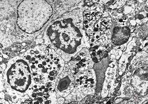 F,1y. | eosinophilic granuloma - Charcot- Leyden crystals